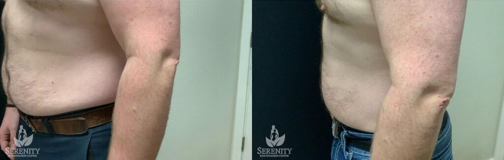 CoolSculpting before and after photo by Dr. Stephen O’Connell in Bellevue, WA