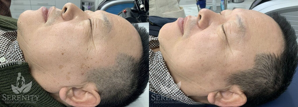 PicoSure® Pro Focus before and after photo by Dr. Stephen Oconnell in Bellevue WA