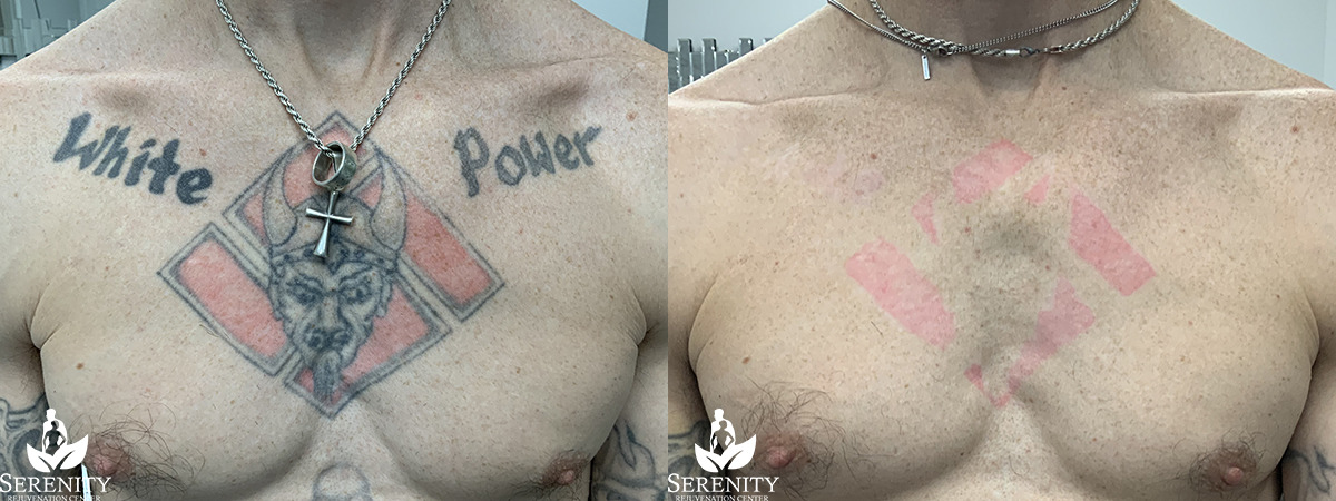 Picosure Tattoo Removal before and after photo by Dr. Stephen Oconnell in Bellevue WA